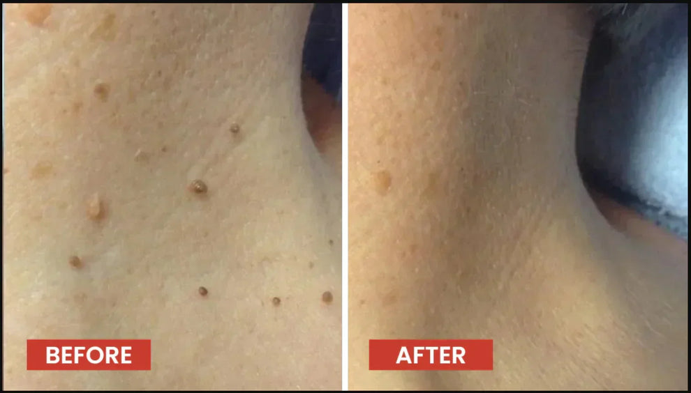 DERMA SMOOTH® SKIN TAG REMOVER PATCH – 72 Patches