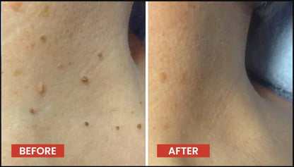 DERMA SMOOTH® SKIN TAG REMOVER PATCH – 72 Patches